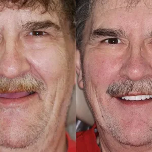 HZA™ Custom-Fit Functional Dentures
