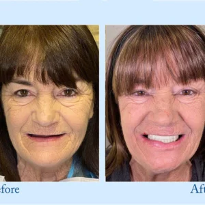 Hidone® Advanced Customized Full Denture Set image Hidone® Advanced Customized Full Denture