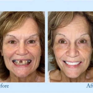 Hidone® Advanced Customized Full Denture Set image Hidone® Advanced Customized Full Denture