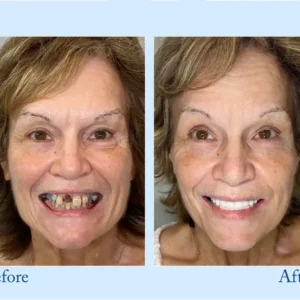 NESLEMY™ Custom-Fit Functional Dentures