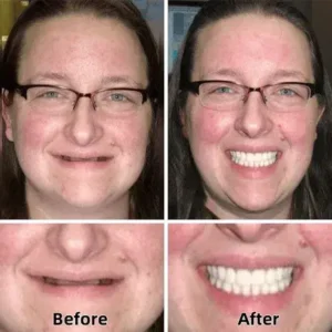 Tenowsy™-Advanced Custom-Fit Functional Dentures