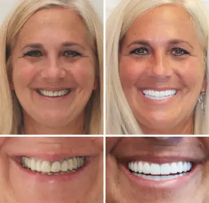 NESLEMY™Advanced Customized Full Denture Set image NESLEMY™Advanced Customized Full Denture Set