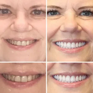 NESLEMY™Advanced Customized Full Denture Set image NESLEMY™Advanced Customized Full Denture Set