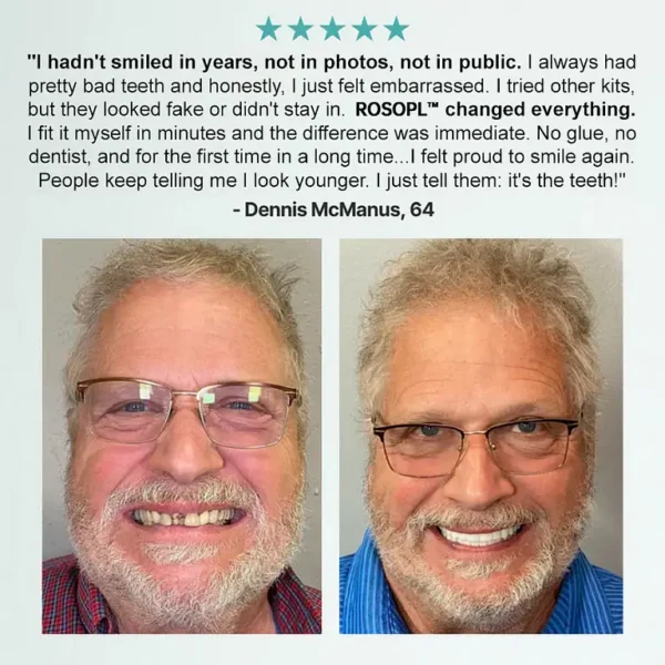 ROSOPL™ Advanced Customized Full Denture Set