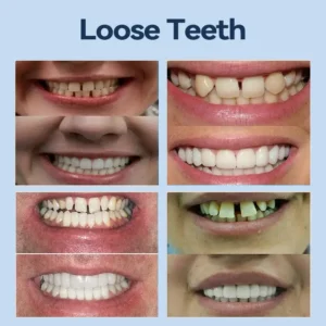 YUNPSO™– Premium Adaptive Dentures