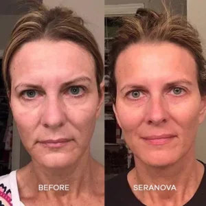 Newyuo® hydrating, moisturizing, anti-wrinkle, firming micro needles