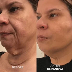 Newyuo® hydrating, moisturizing, anti-wrinkle, firming micro needles