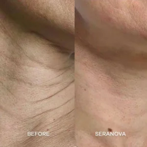 Newyuo® hydrating, moisturizing, anti-wrinkle, firming micro needles