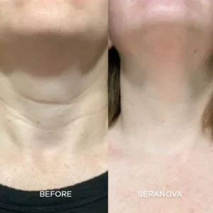 Newyuo® hydrating, moisturizing, anti-wrinkle, firming micro needles