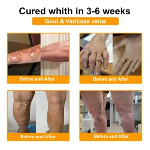 ADNOON® Botulinum Toxin & Bee Venom Pain-Relief Bone Healing Cream