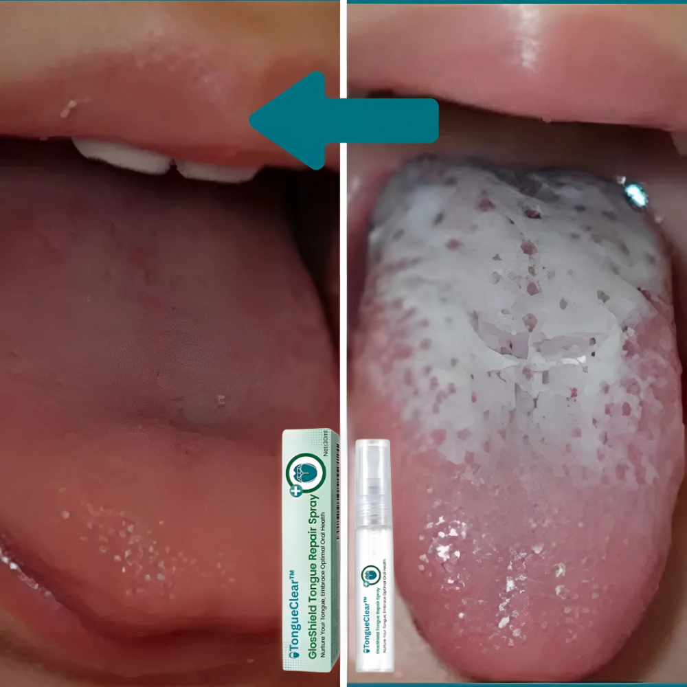 TongueClear™ | Relieves sore tongue and white coating image TongueClear™ | Relieves sore tongue and white coating