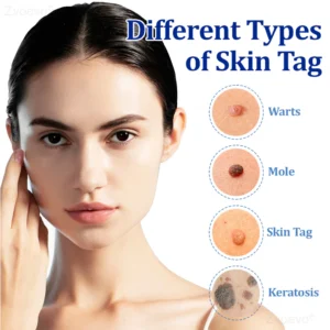 Zvoevo® BeeDerm RX Cream, Painless, Targeted Treatment image Zvoevo® BeeDerm RX Cream, Painless, Targeted Treatment