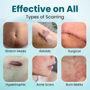 Zvoevo® Advanced Scar Gel