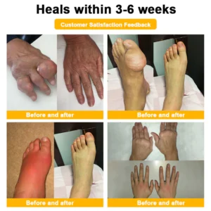 ADNOON® Botulinum Toxin & Bee Venom Pain-Relief Bone Healing Cream