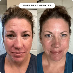 Newyuo® hydrating, moisturizing, anti-wrinkle, firming micro needles