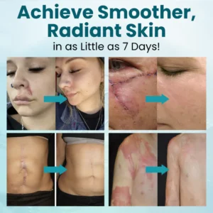 Zvoevo® Advanced Scar Gel