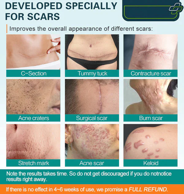Advanced Scar Spray For All Types of Scars image Advanced Scar Spray For All Types of Scars