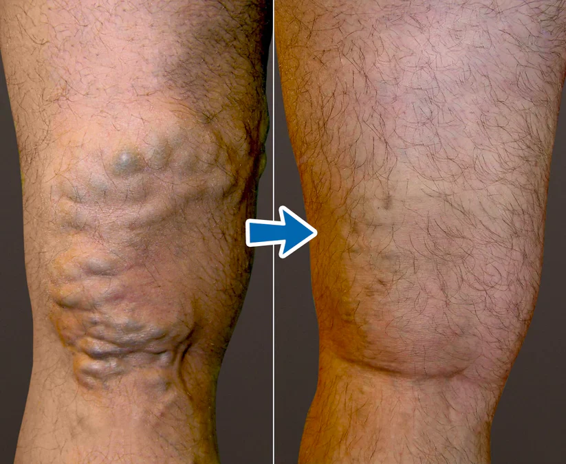 Cvreoz® VenoAid PRO Varicose Solution Spray image Cvreoz® VenoAid PRO Varicose Solution Spray