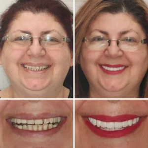 BQYOOM™ Premium Dentures image BQYOOM™ Premium Dentures