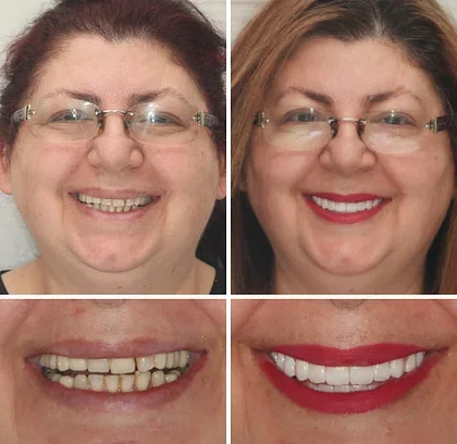 BQYOOM™ Premium Dentures image BQYOOM™ Premium Dentures