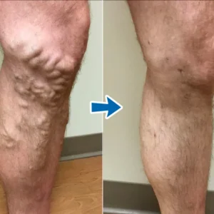 Cvreoz® VenoAid PRO Varicose Solution Spray image Cvreoz® VenoAid PRO Varicose Solution Spray