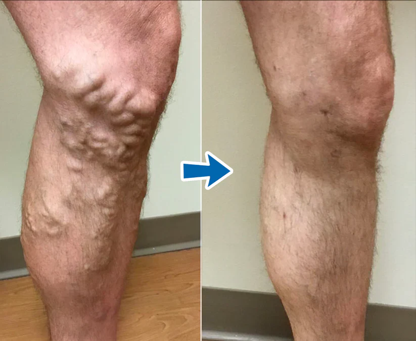 Cvreoz® VenoAid PRO Varicose Solution Spray image Cvreoz® VenoAid PRO Varicose Solution Spray