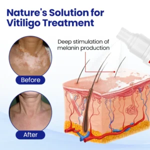 CVREOZ® Vitiligo Herbal Spray image CVREOZ® Vitiligo Herbal Spray