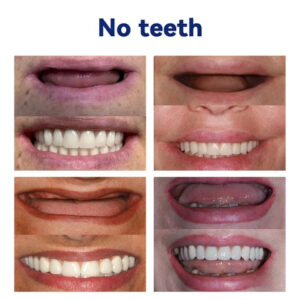 NESLEMY-Advanced Customized Full Denture Set image NESLEMY-Advanced Customized Full Denture Set