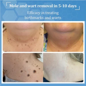 Zvoevo® BeeDerm RX Cream, Painless, Targeted Treatment image Zvoevo® BeeDerm RX Cream, Painless, Targeted Treatment