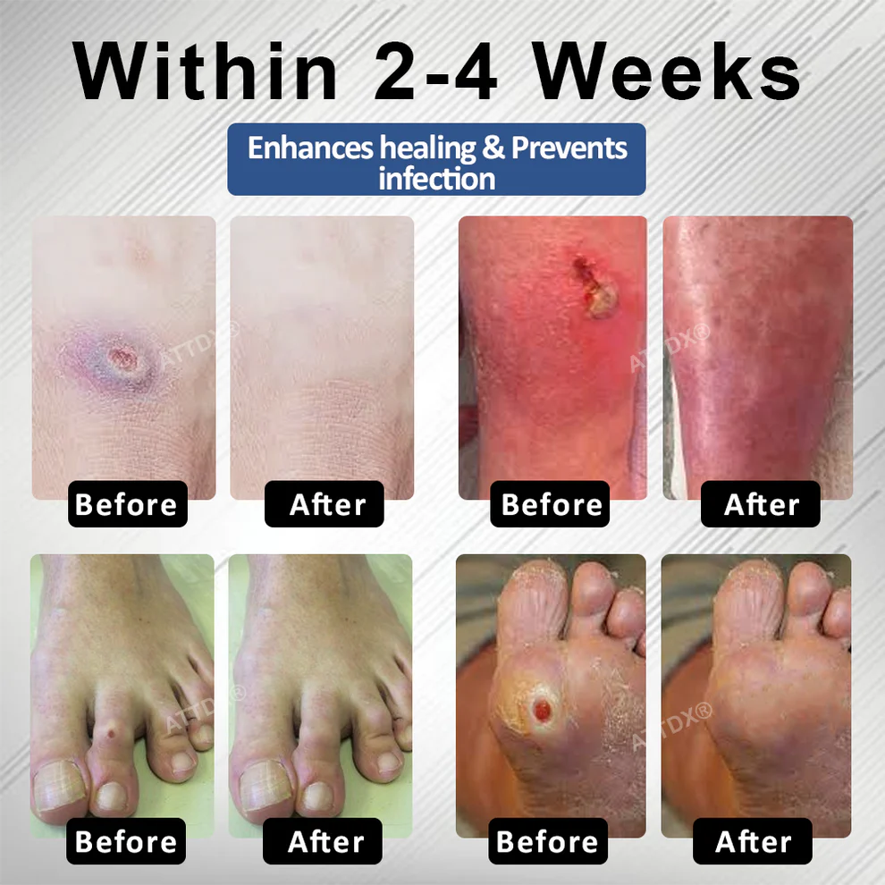 CVREOZ® Diabetes Foot Guard Fast Recovery Spray image CVREOZ® Diabetes Foot Guard Fast Recovery Spray