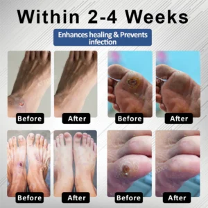 CVREOZ® Diabetes Foot Guard Fast Recovery Spray image CVREOZ® Diabetes Foot Guard Fast Recovery Spray