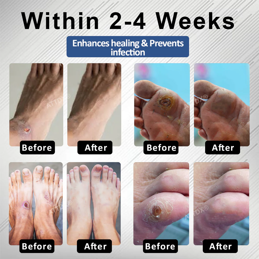 CVREOZ® Diabetes Foot Guard Fast Recovery Spray image CVREOZ® Diabetes Foot Guard Fast Recovery Spray