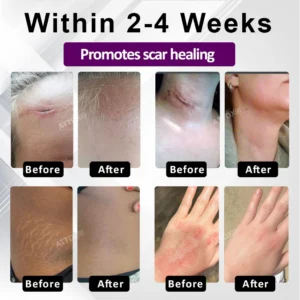 ATTDX® NanoHeal Advanced Face & Body Scar Gel