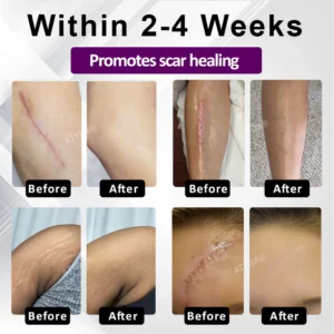 ATTDX® NanoHeal Advanced Face & Body Scar Gel