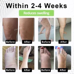 Oveallgo® CircuPro Edema & Lymphatic Support Inhaler image Oveallgo® CircuPro Edema & Lymphatic Support Inhaler