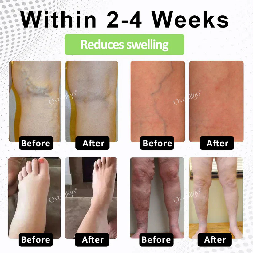 Oveallgo® CircuPro Edema & Lymphatic Support Inhaler image Oveallgo® CircuPro Edema & Lymphatic Support Inhaler