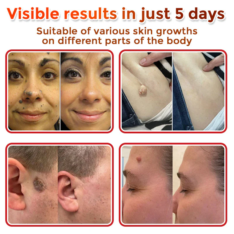 Fivfivgo® MicroNeedle Botanic Skin Tag Removal Patch 4 Fivfivgo® MicroNeedle Botanic Skin Tag Removal Patch