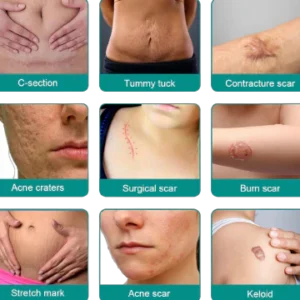Fivfivgo™ Advanced Scar Removal Spray 5 Fivfivgo™ Advanced Scar Removal Spray