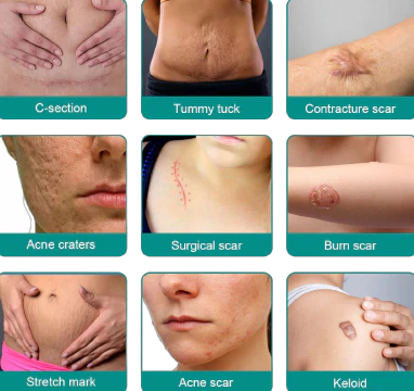 Fivfivgo™ Advanced Scar Removal Spray 2 Fivfivgo™ Advanced Scar Removal Spray