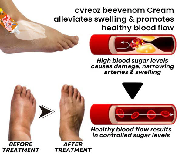 Cvreoz® Bee Venom Diabetic Wounds Treatment Cream image Cvreoz® Bee Venom Diabetic Wounds Treatment Cream