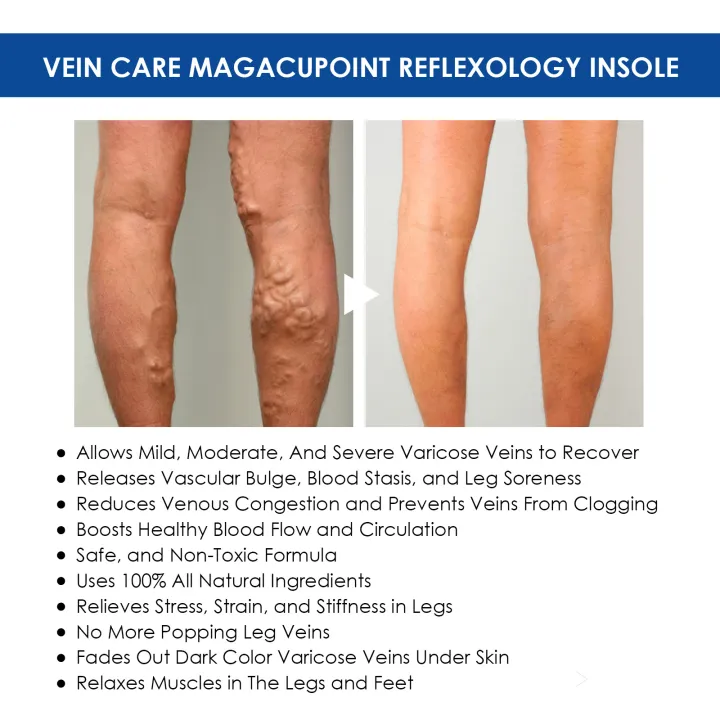 Oveallgo™ VeinCare MagAcupoint Reflexology Insole image Oveallgo™ VeinCare MagAcupoint Reflexology Insole