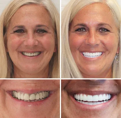 BQYOOM™ Premium Dentures image BQYOOM™ Premium Dentures