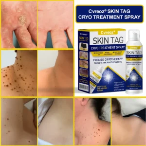 Cvreoz® Skin Tag Cryo Treatment Spray