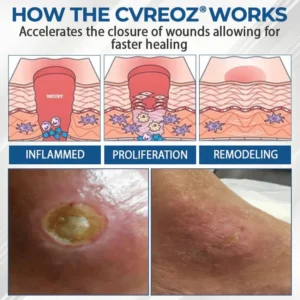 CVREOZ® Diabetes Foot Guard Fast Recovery Spray image CVREOZ® Diabetes Foot Guard Fast Recovery Spray