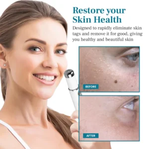 DAFEILA® LumeSkin Mole and Wart Removal Laser Pen