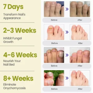 Cvreoz® Nail Fungal Patches Pro+ image Cvreoz® Nail Fungal Patches Pro+